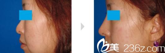 小木曾佑一隆鼻手术前后对比