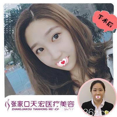 张家口天宏做双眼皮案例