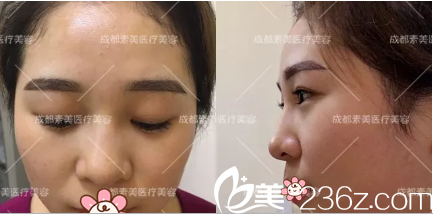 在素美做膨体隆鼻术前照片 在素美做膨体隆鼻术前照片