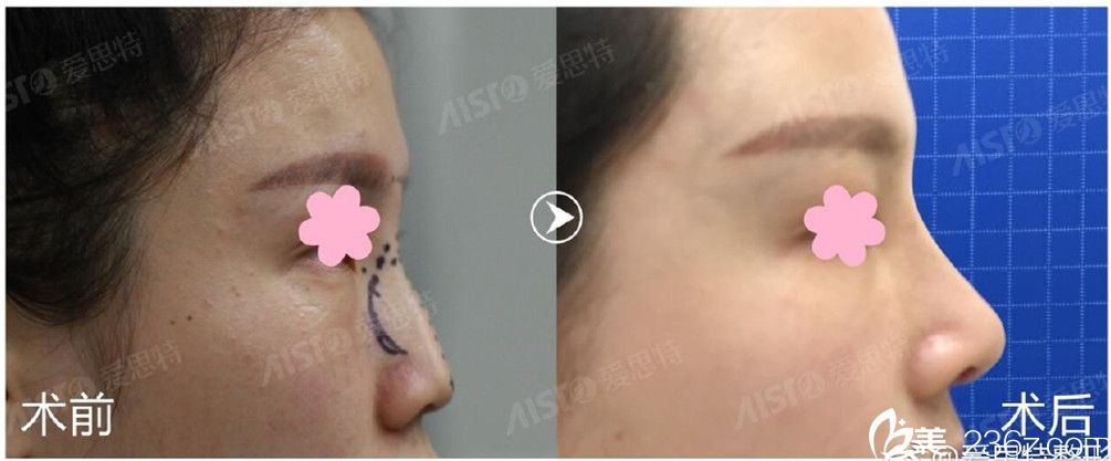 杨迪院长隆鼻前后对比图 杨迪院长隆鼻前后对比图