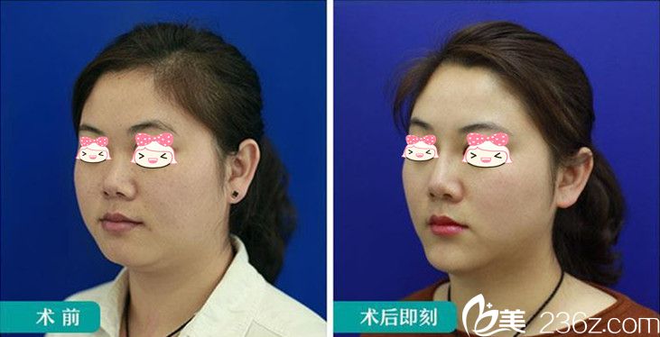 在爱思特隆鼻+玻尿酸丰下巴效果图 在爱思特隆鼻+玻尿酸丰下巴效果图