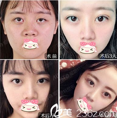 我在整形医院做双眼皮前后变化图 我在整形医院做双眼皮前后变化图