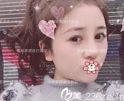 <!--<i data=20240703-sp></i>-->欧美混血美鼻术后10天效果 <!--<i data=20240703-sp></i>-->欧美混血美鼻术后10天效果