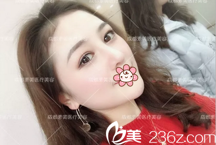 膨体隆鼻术后一个月恢复照片 膨体隆鼻术后一个月恢复照片