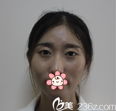 双眼皮手术前素颜照片 双眼皮手术前素颜照片