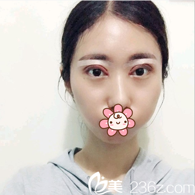 车红昌切开双眼皮开眼角术后当天 车红昌切开双眼皮开眼角术后当天