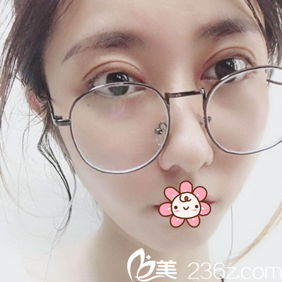 切开双眼皮术后10天恢复效果 切开双眼皮术后10天恢复效果