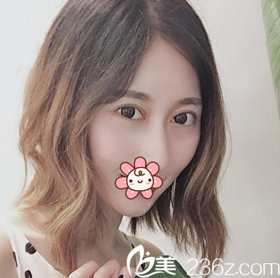 车红昌切开双眼皮术后一个月 车红昌切开双眼皮术后一个月