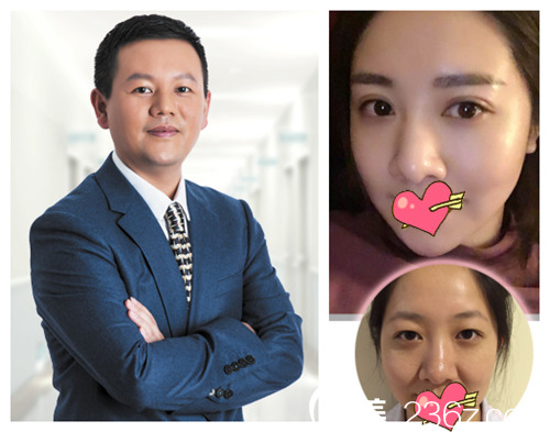 整形金志杨眼综合案例 整形金志杨眼综合案例