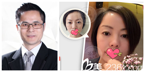 曾海波院长线雕前后真人对比 曾海波院长线雕前后真人对比