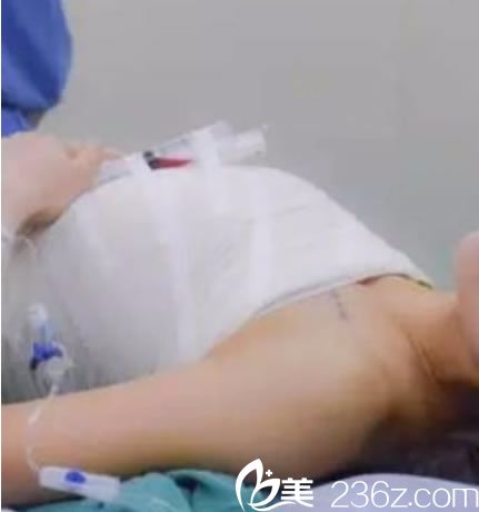 杭州甄美刚做完假体隆胸图片