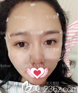 术后天效果 术后天效果