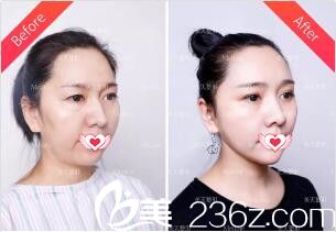 术后2周时与术前对比效果 术后2周时与术前对比效果