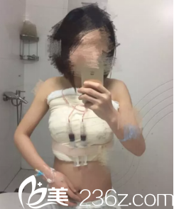 青岛华韩做假体隆胸手术挺好的，分享青岛华韩真人隆胸日记给你参考