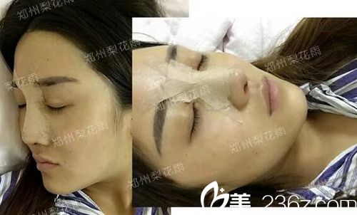 顾客周周在郑州梨花雨做隆鼻修复术后