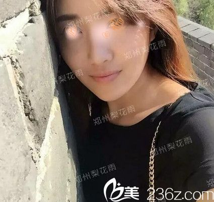 在北京隆鼻失败后的她选择郑州梨花雨做隆鼻修复获得重生