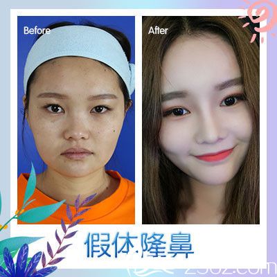 广州广美徐立志隆鼻案例 广州广美徐立志隆鼻案例