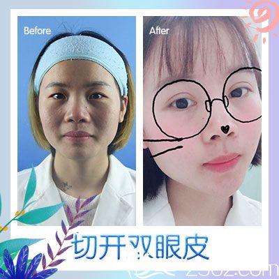 广州广美徐立志双眼皮案例图片 广州广美徐立志双眼皮案例图片
