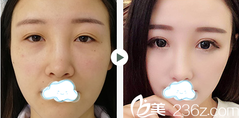 刘海兰双眼皮修复术前术后对比