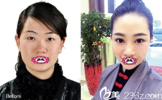医疗美容李超院长双眼皮前后变化图 医疗美容李超院长双眼皮前后变化图