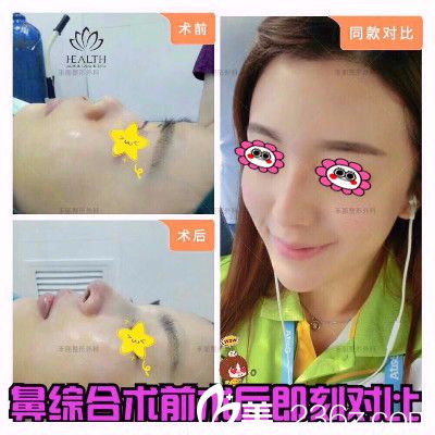 的彭炜峰为我做的鼻综合<span style= 的彭炜峰为我做的鼻综合<span style=