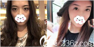 胡俊杰主任全面部自体脂肪填充案例 胡俊杰主任全面部自体脂肪填充案例