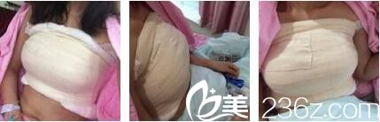 上海瑞芙臣医疗美容门诊部范小龙假体隆胸真人案例术后第五天