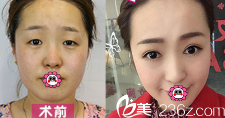 北京惠合嘉美切开双眼皮案例