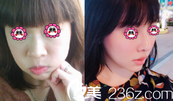 北京惠合嘉美胡俊峰耳软骨复合隆鼻案例