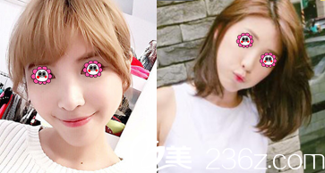 北京惠合嘉美瘦脸除皱瘦脸案例