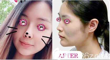 北京惠合嘉美医院隆鼻多少钱？达拉斯定制鼻综合15800元起