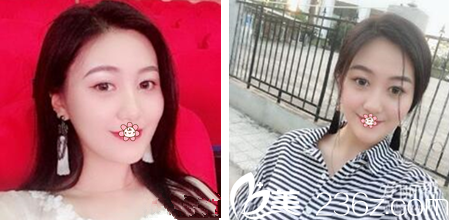 重庆好美整形双眼皮怎么样 重庆好美整形双眼皮怎么样