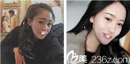 重庆好美整形双眼皮术后3个月效果 重庆好美整形双眼皮术后3个月效果