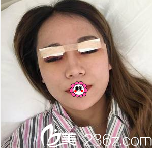 <!--<i data=20240703-sp></i>-->医生给我做切开双眼皮手术当天样子