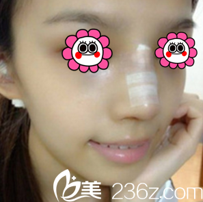 胡俊峰医生给我做鼻综合第4天样子 胡俊峰医生给我做鼻综合第4天样子