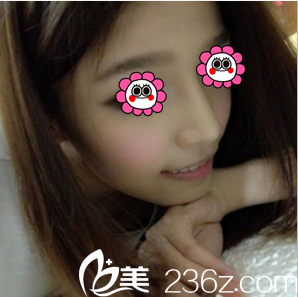 在北京惠合嘉美做膨体+耳软骨综合隆鼻第23天效果 在北京惠合嘉美做膨体+耳软骨综合隆鼻第23天效果