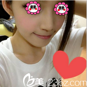 北京惠合嘉美膨体+耳软骨鼻综合案例 北京惠合嘉美膨体+耳软骨鼻综合案例