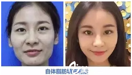 邵阳德美自体脂肪填充前后对比