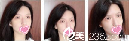 上海博爱医院整形美容科徐剑炜全切双眼皮真人案例术后第七天