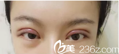 李明钟给我做双眼皮3天了 李明钟给我做双眼皮3天了