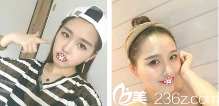 一周后样子 一周后样子