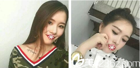 重庆好美整形埋线提升术后一个月效果 重庆好美整形埋线提升术后一个月效果