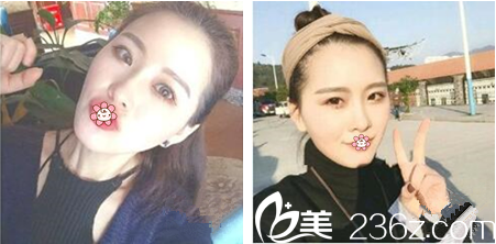 重庆好美整形杨东运埋线提升术后2个月 重庆好美整形杨东运埋线提升术后2个月