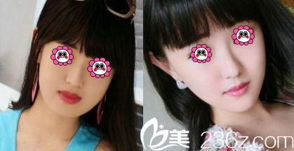 北京瑞妍茗医面部吸脂多少钱？面部单部位吸脂2499元起附案例