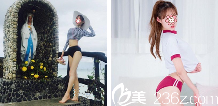 毕胜腰腹吸脂术后半个月