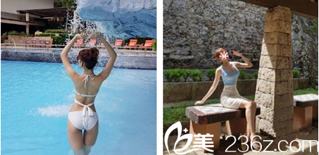 重庆好美整形吸脂术后三个月