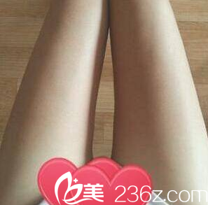 北京惠合嘉美腿部吸脂案例