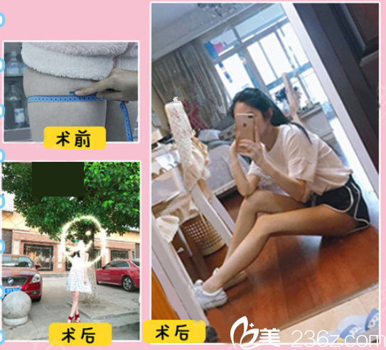 赣州亚韩360°水动力吸脂手术，德国进口水动力吸脂仪器，术后安全不反弹，助你成功瘦身