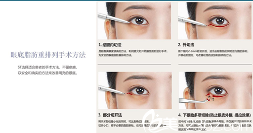 韩国ST医院眼底脂肪重排列手术方法