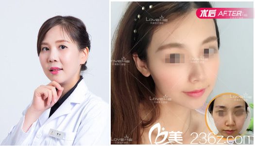 武汉乐美汪文娟面部线雕案例 武汉乐美汪文娟面部线雕案例